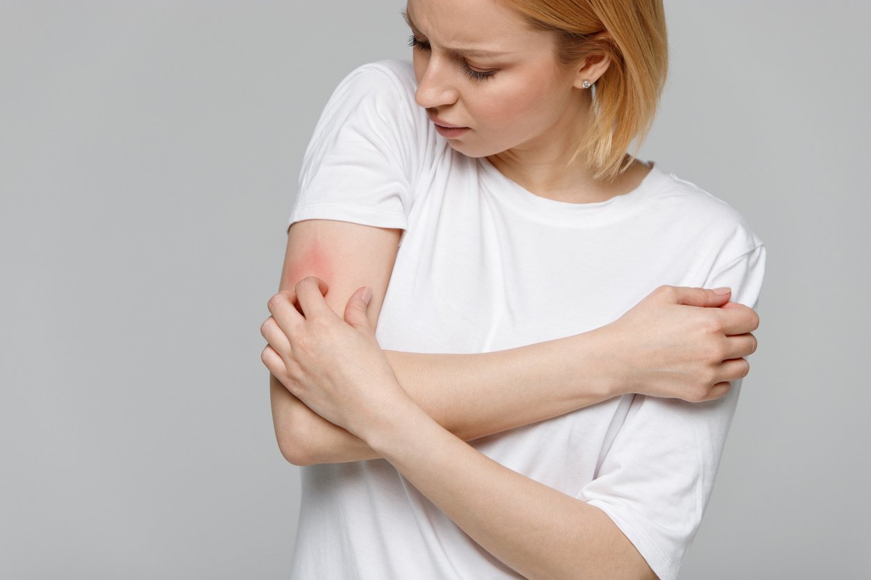 Woman Scratching the Itch on Her Hand. Dry Skin, Animal/Food All